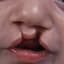 cleftlip